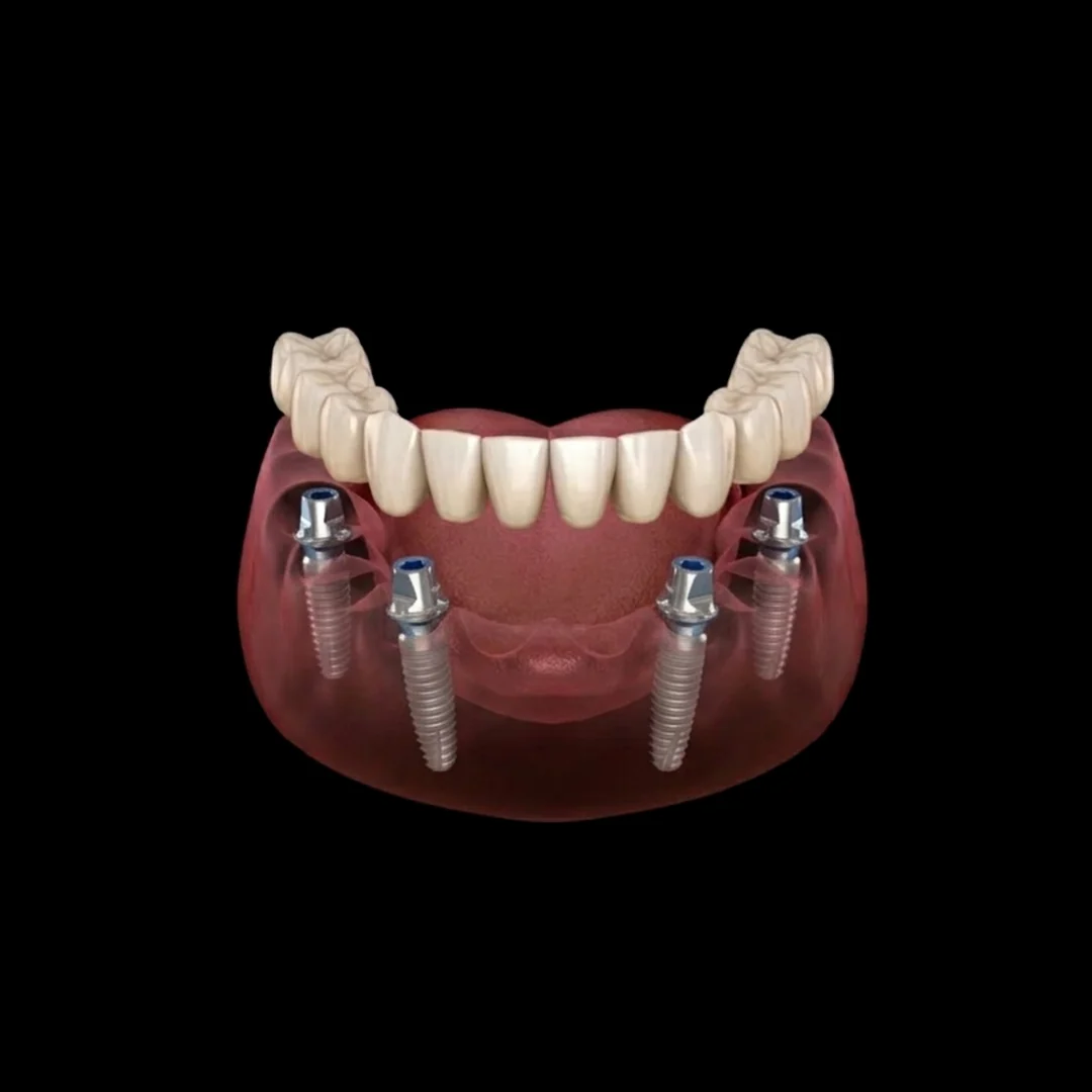 New Life Full Arch system with 4 implants supporting a fixed lower arch